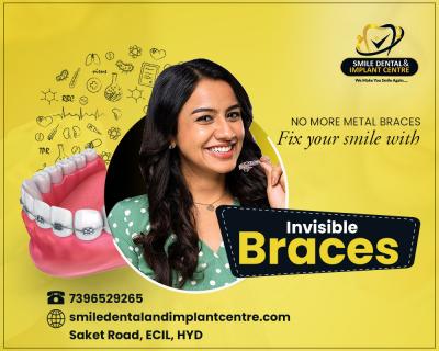 Invisalign aligners