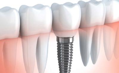 dental implans in india